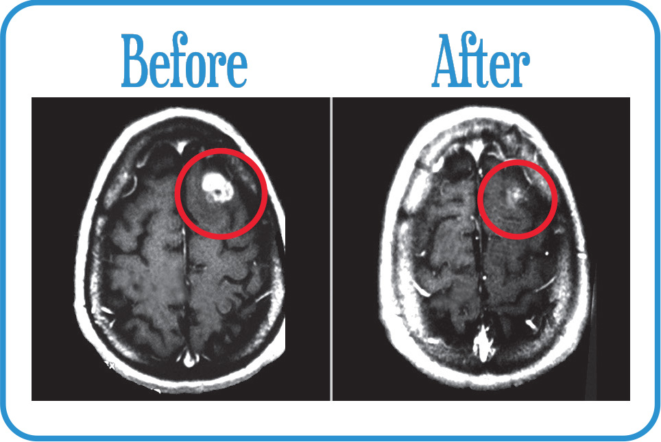 Head and Neck Cancers