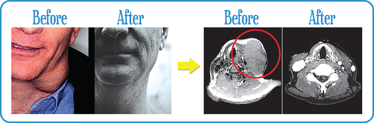 Head and Neck Cancers