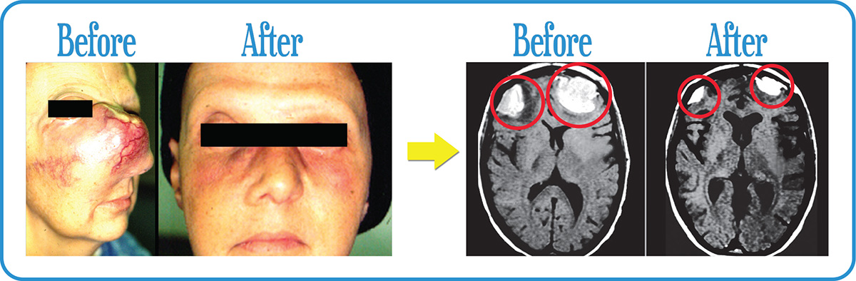 Head and Neck Cancers