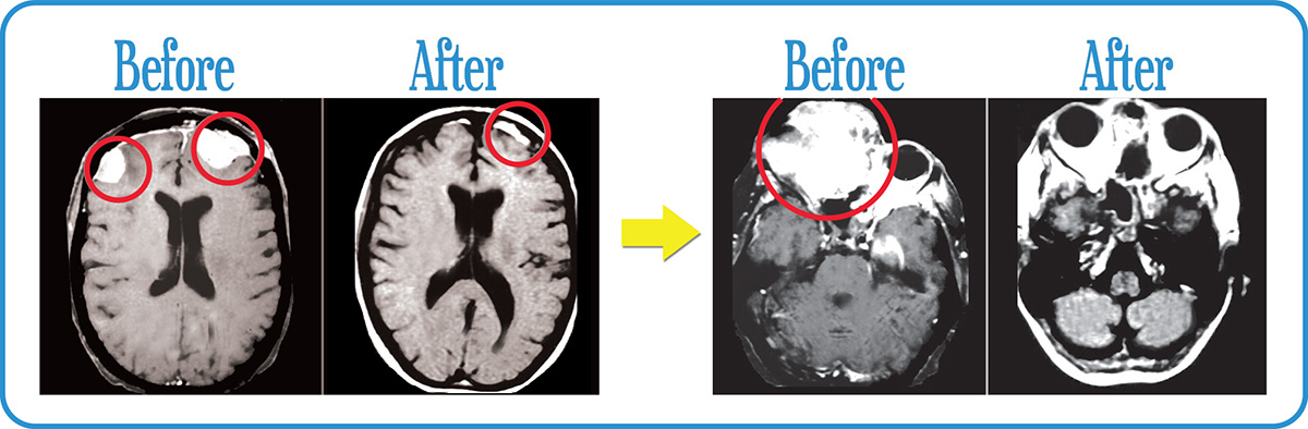 Head and Neck Cancers