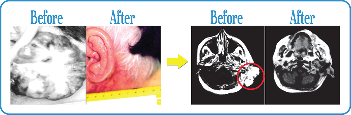 Head and Neck Cancers