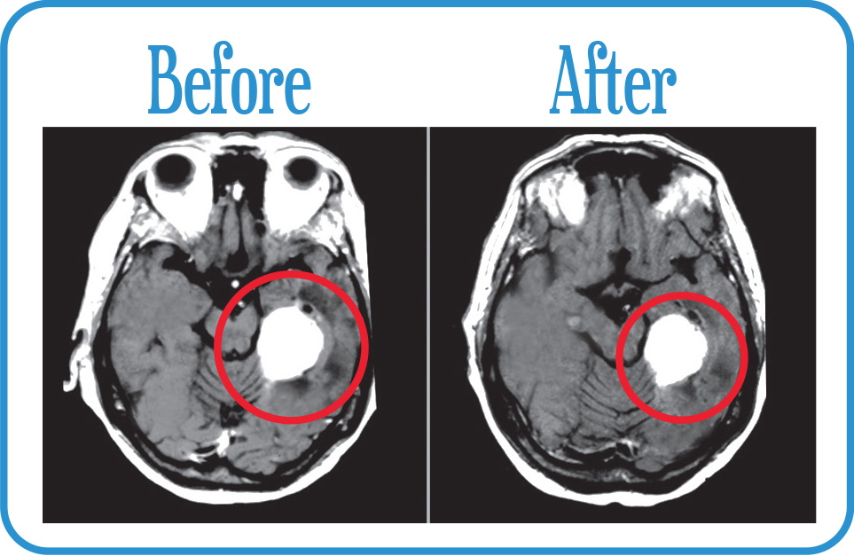 Meningioma