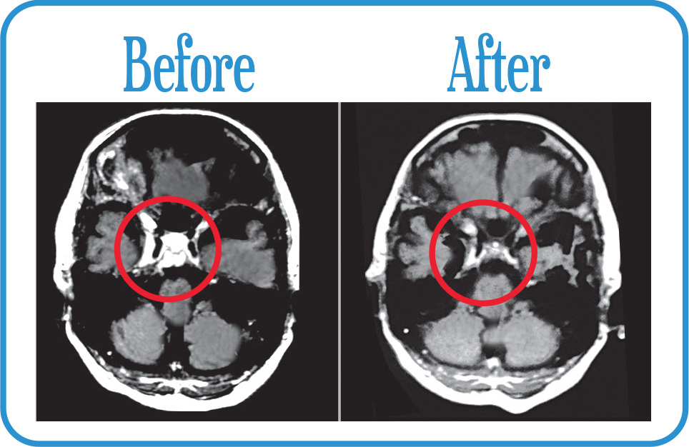 Meningioma