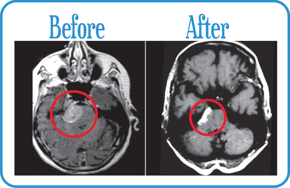 Meningioma