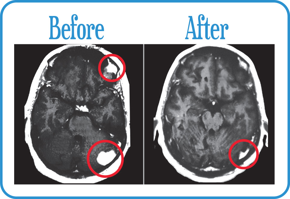 Brain Metastases