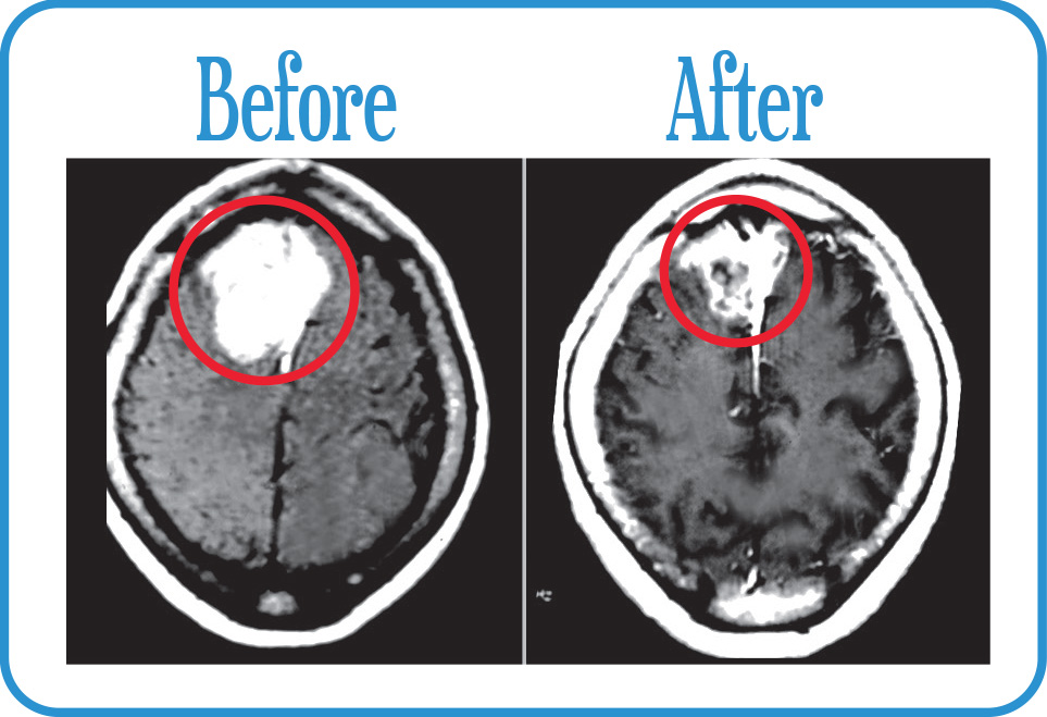 Brain Metastases