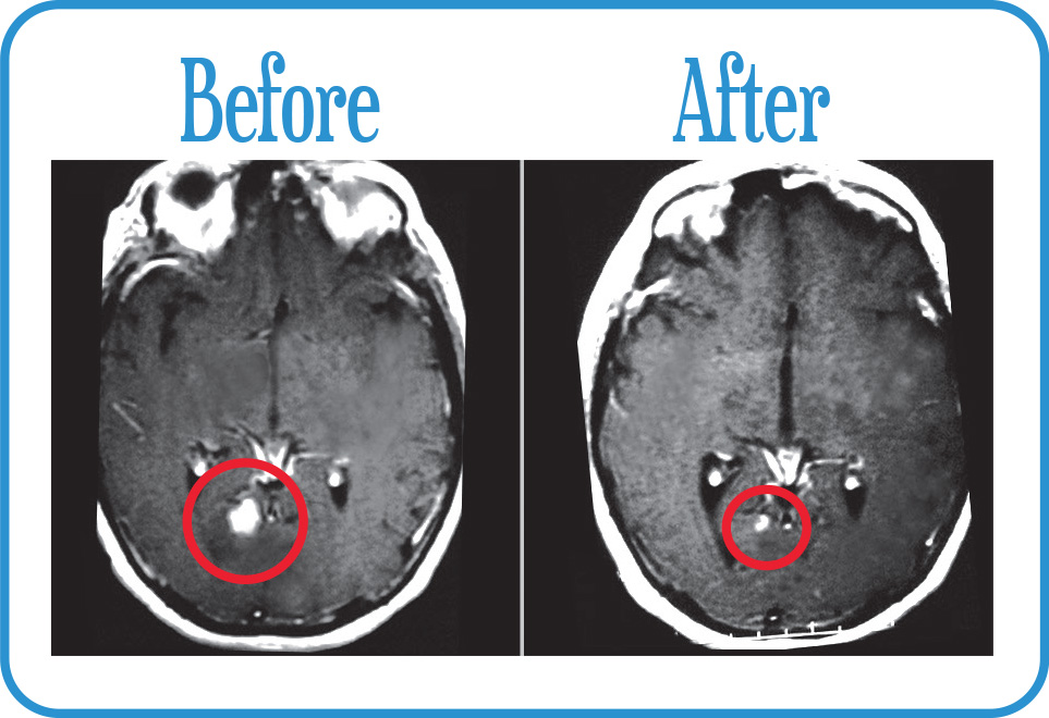 Brain Metastases