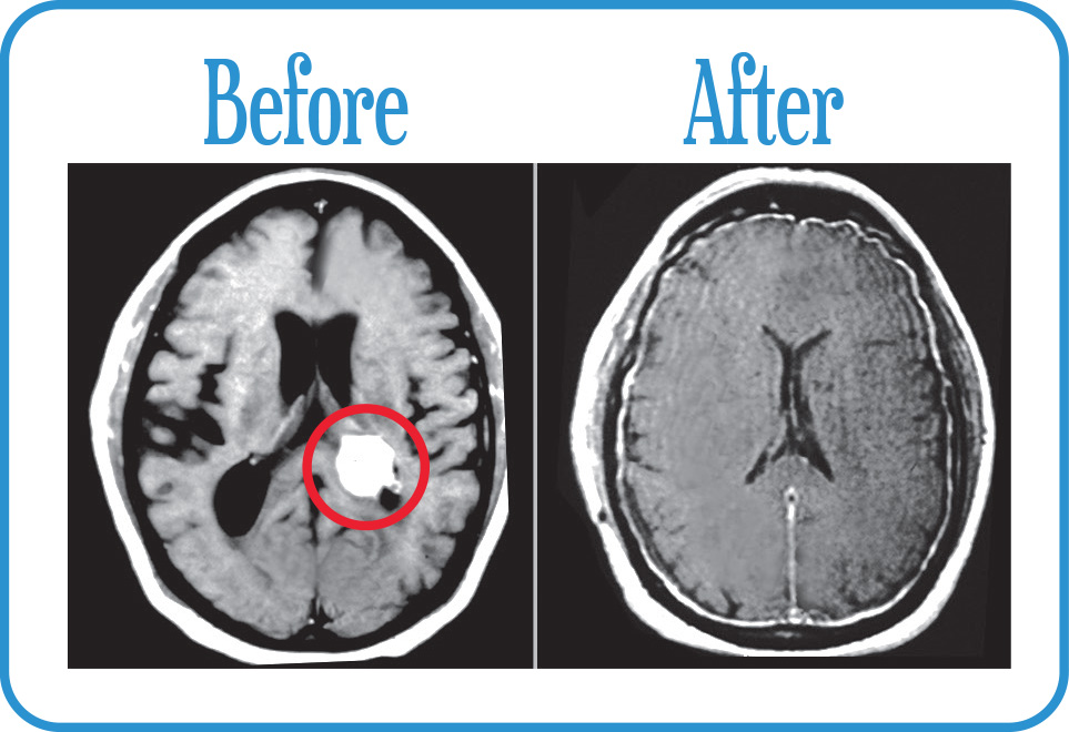 Brain Metastases