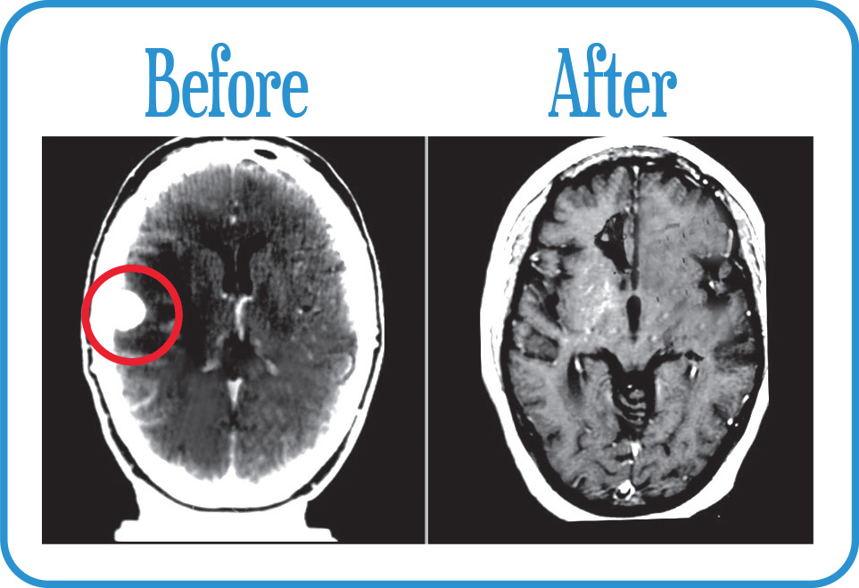 Brain Metastases