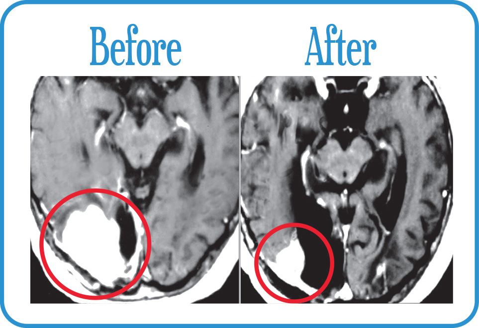 Brain Metastases