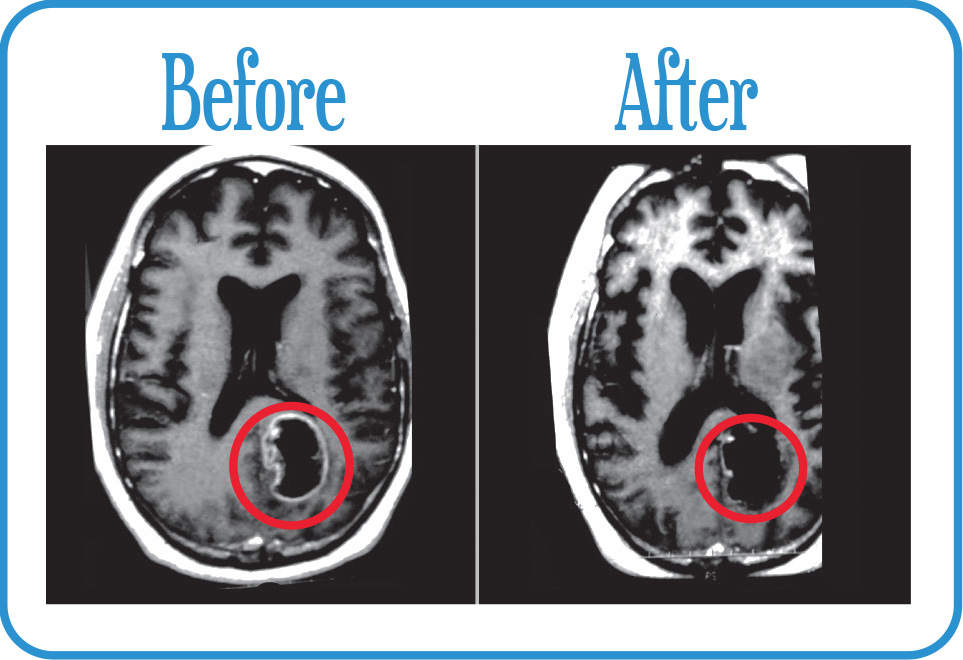 Brain Metastases