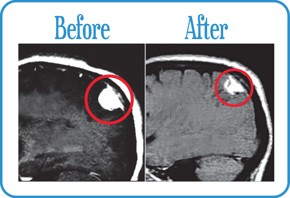 Brain Metastases