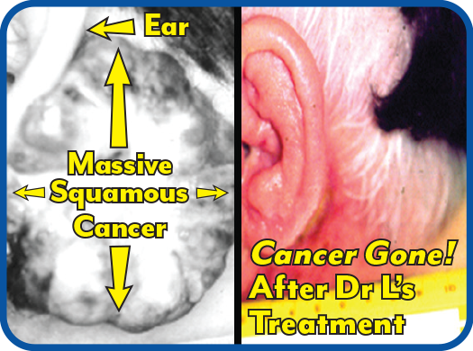 Massive Squamous Cancer