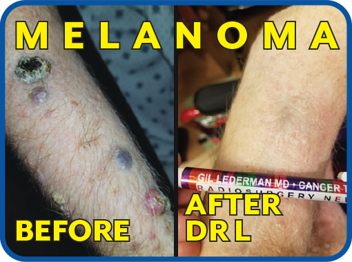 Melanoma