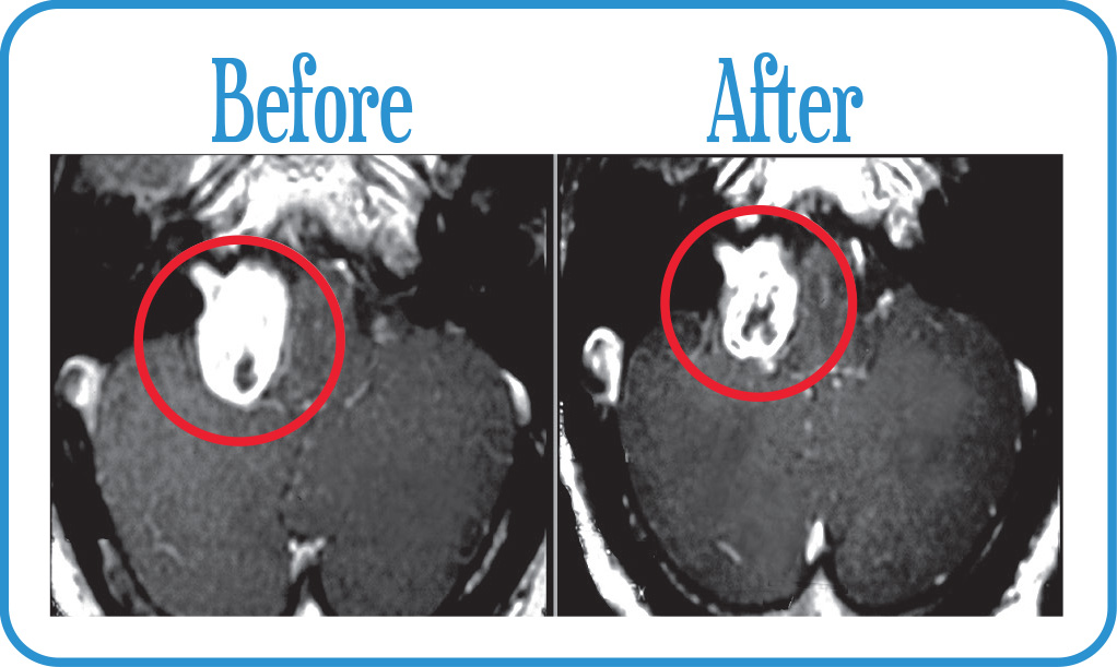 Acoustic Neuroma NF2