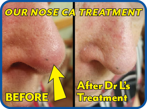 Our Nose Treatment