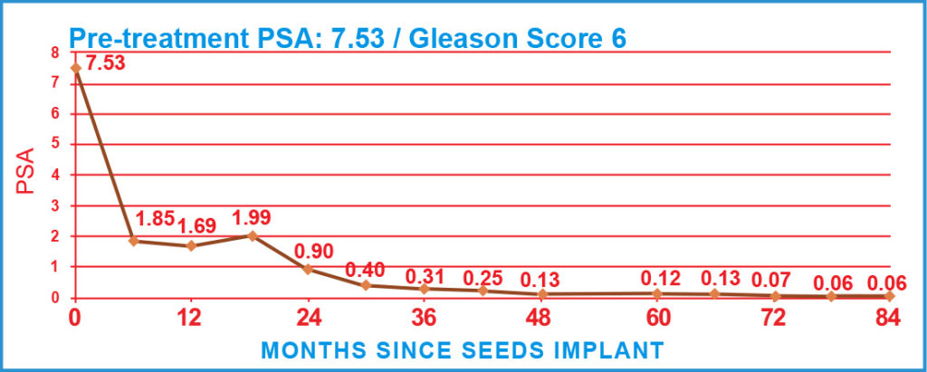 PSA Charts of Prostate Cancer