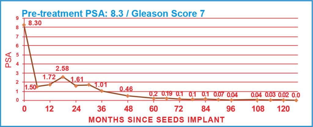 PSA Charts of Prostate Cancer