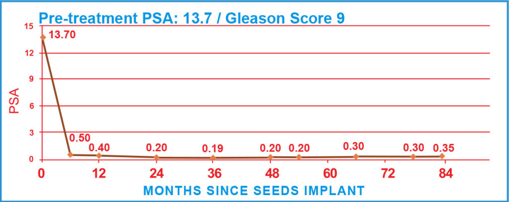 PSA Charts of Prostate Cancer