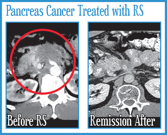 Pancreas Cancer Treated with Radiosurgery