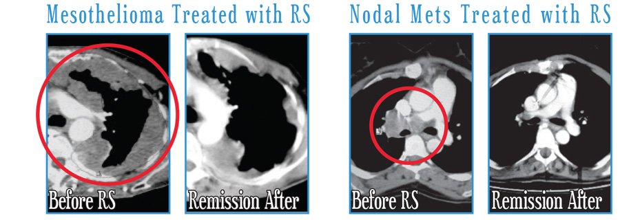 Mesothelioma Treated with Radiosurgery