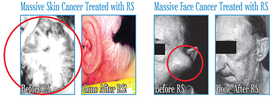 Massive Skin Cancer Treated with Radiosurgery.