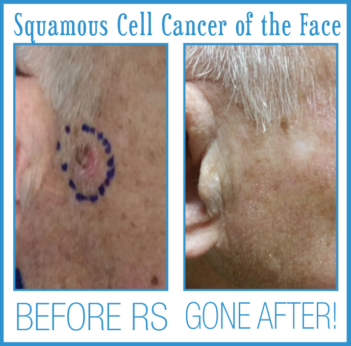 Squamous Cell Cancer of the Face Before and After Radiosurgery