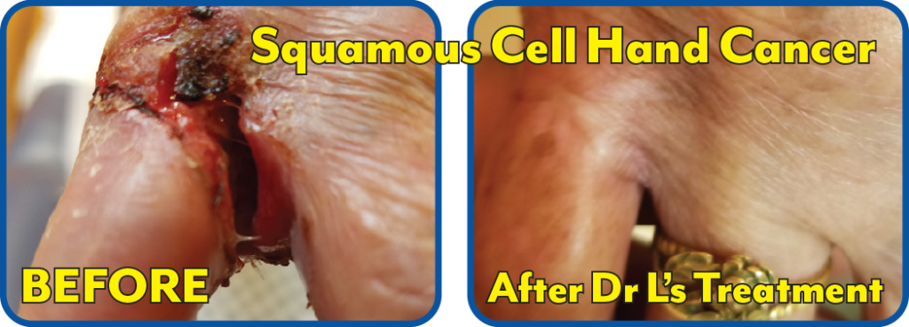 Squamous Cell Hand Cancer