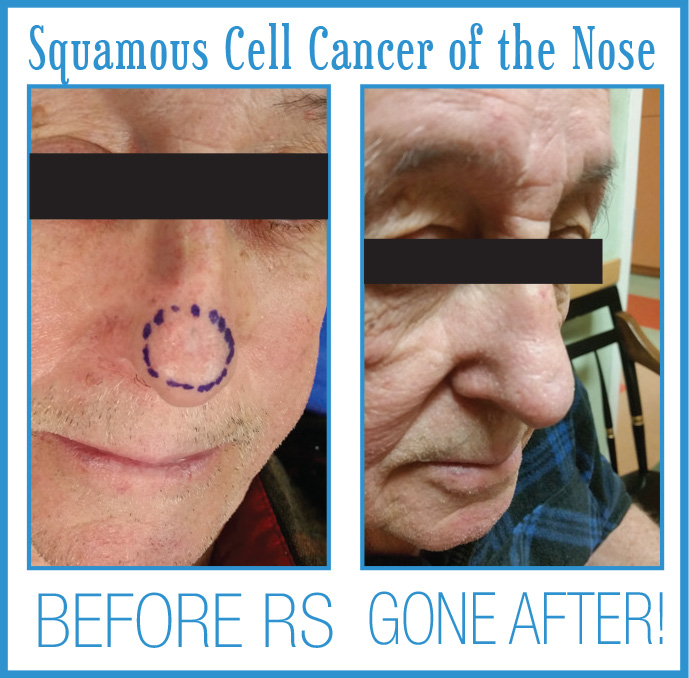 Squamous Cell Cancer Before and After Radiosurgery