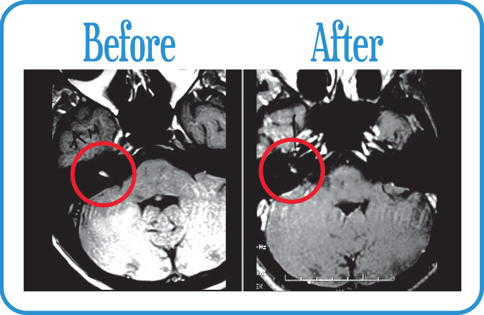 Tiny Intracanicular Acoustic Neuroma